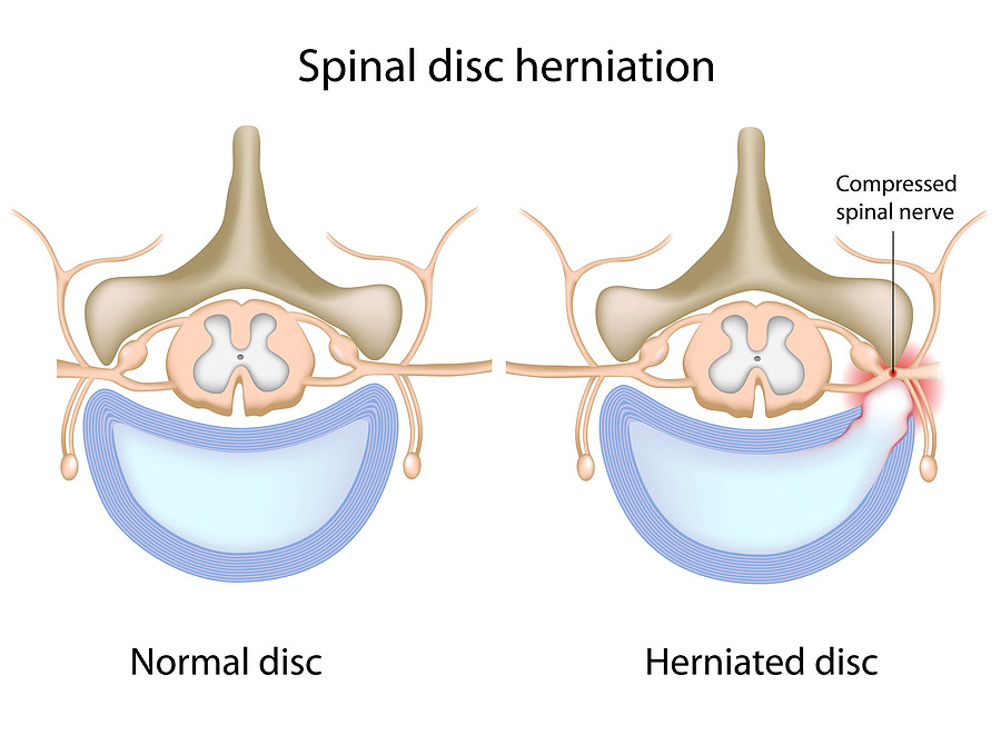 Herniated/Bulging Disc - Advanced Pain Relief Clinic